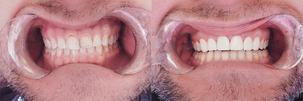 teeth before and after treatment