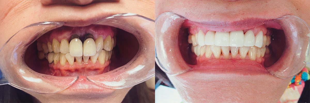 teeth before and after treatment