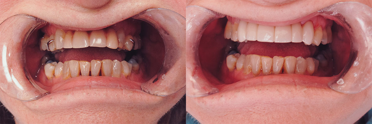 teeth before and after treatment