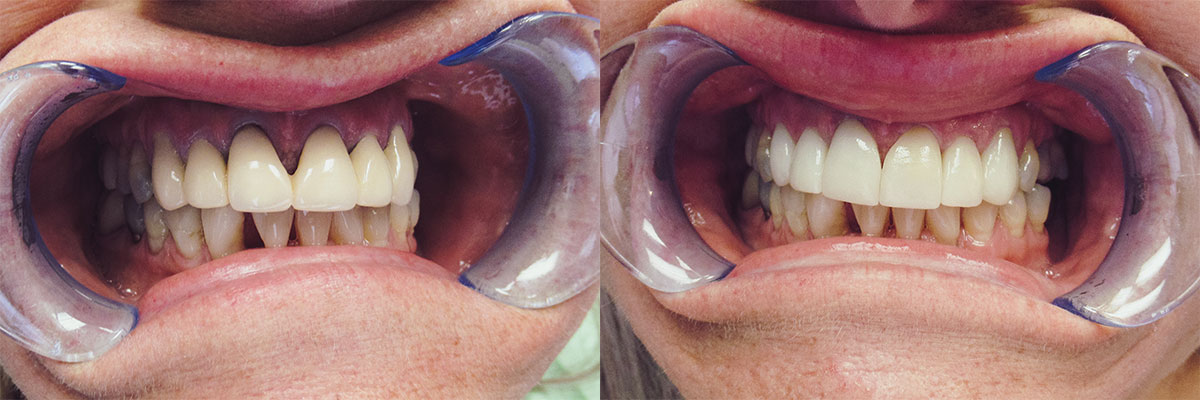 teeth before and after treatment