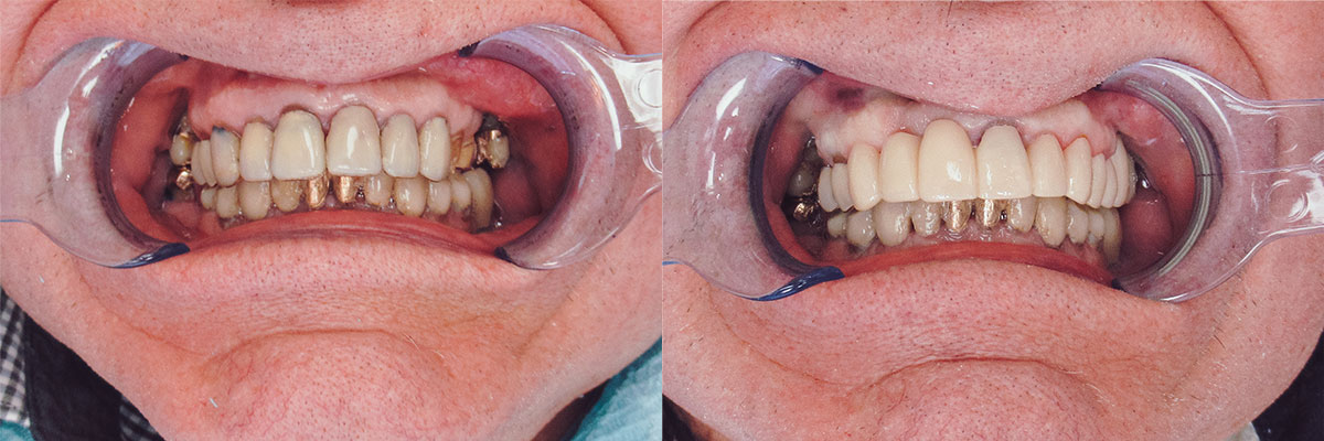 teeth before and after treatment