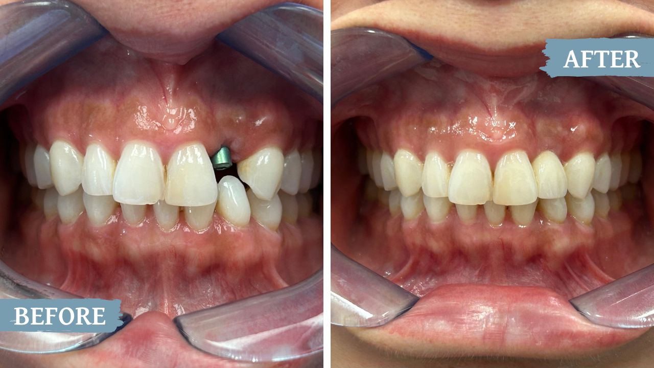 teeth before and after treatment
