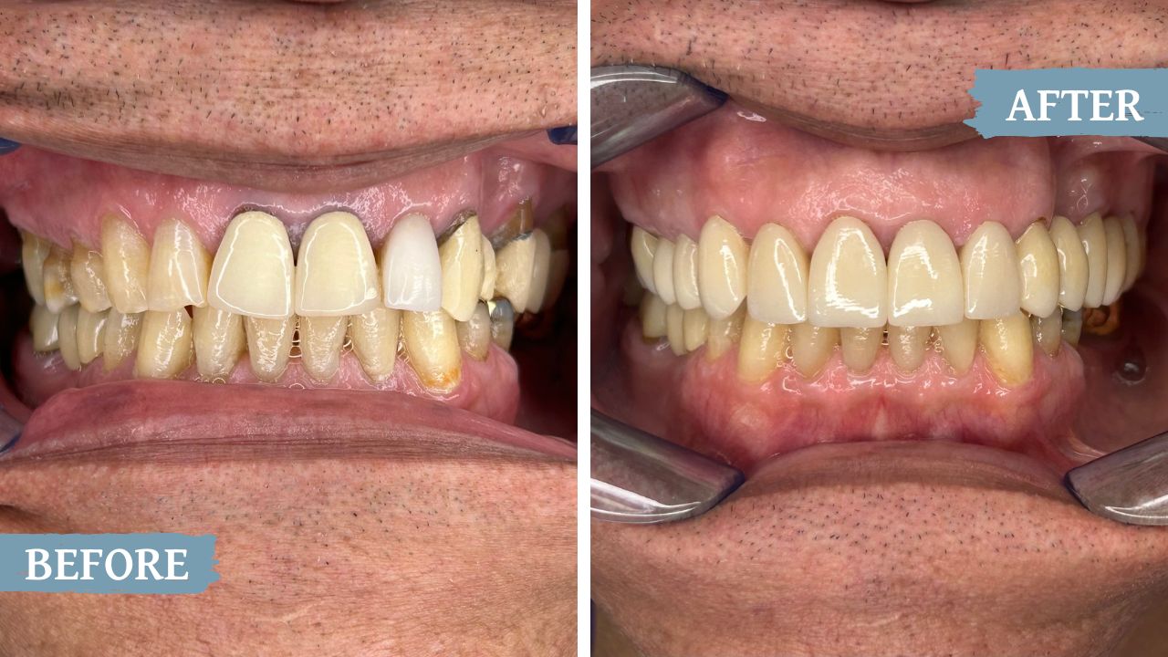 teeth before and after treatment